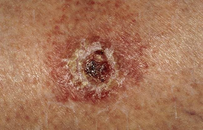 open sore on 5 signs of skin cancer other than a new mole open sore on 5 signs of skin cancer other than a new mole
